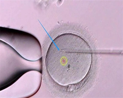 浙江捐助卵子，浙江试管婴儿做一次多少钱