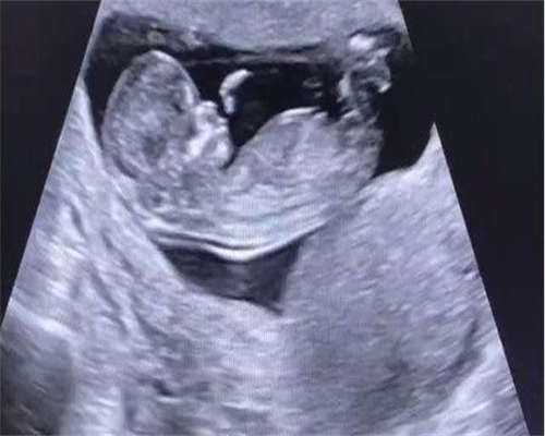 试管婴儿投入大但非百分百成功